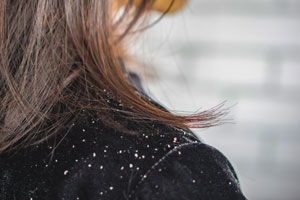 closeup-woman-hair-dandruff-falling