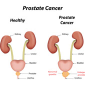 Prostate Cancer