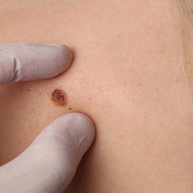 Skin Tags Removal 