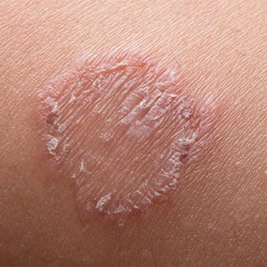 How to combat ringworm infection quickly and painlessly