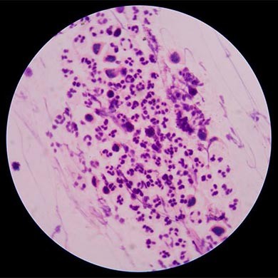 Common Fungal Skin Infections