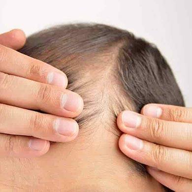 Thinning Hair 101 - All you need to know about hair loss and hair thinning