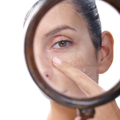 Dark Spots: Tips to handle and prevent them