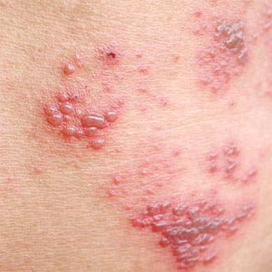 All about Rosacea - Prevention and Solutions