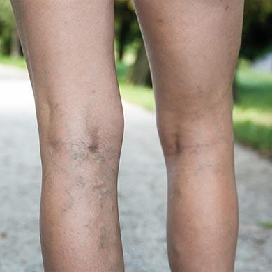 Prevent and get rid of Varicose Veins naturally