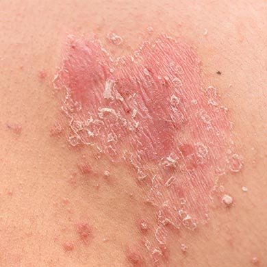 Natural remedies to get relief from Eczema