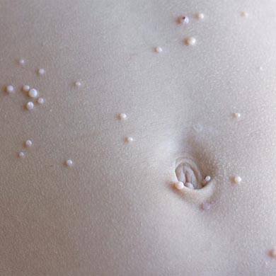 What is Molluscum Contagiosum and it’s treatment