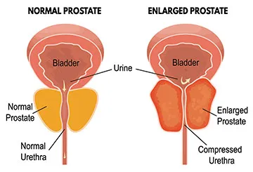 Enlarged Prostate